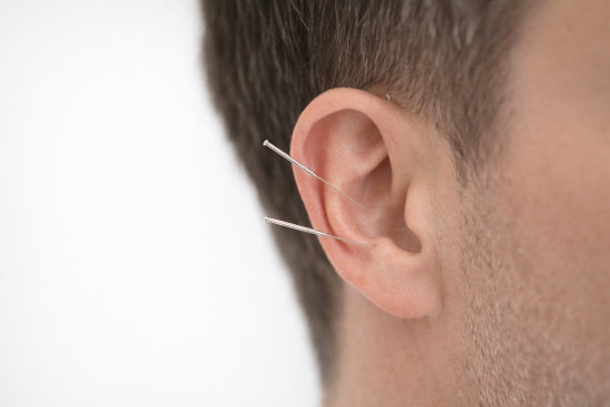 Symbolbild Akupunktur